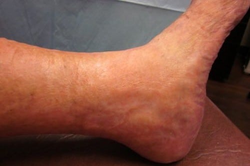 After Image: Venous Ulcer - front