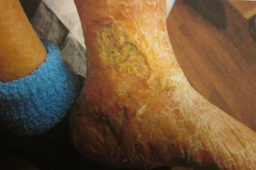 Before Image: Venous Ulcer - front