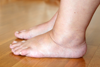 s Venous Insufficiency