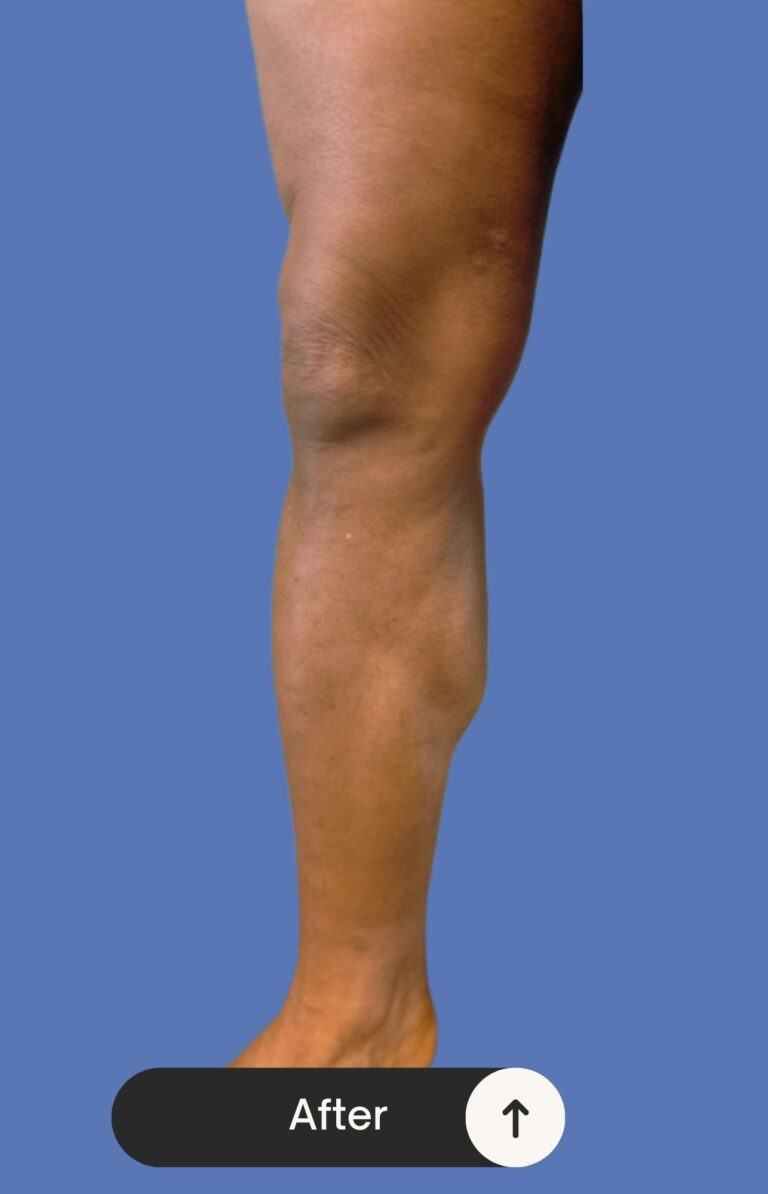 After Image: Radiofrequency Ablation (RFA) and Sclerotherapy - front