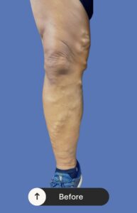 Before Image: Radiofrequency Ablation (RFA) and Sclerotherapy
