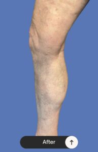 After Image: EVLT and Sclerotherapy