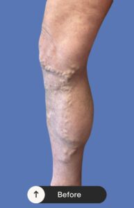 Before Image: EVLT and Sclerotherapy