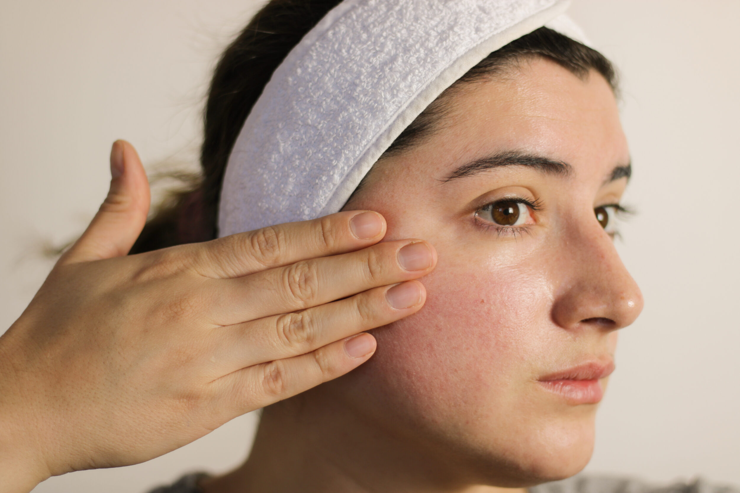 Woman examining her face in the mirror, showing signs of rosacea and facial veins on sensitive skin