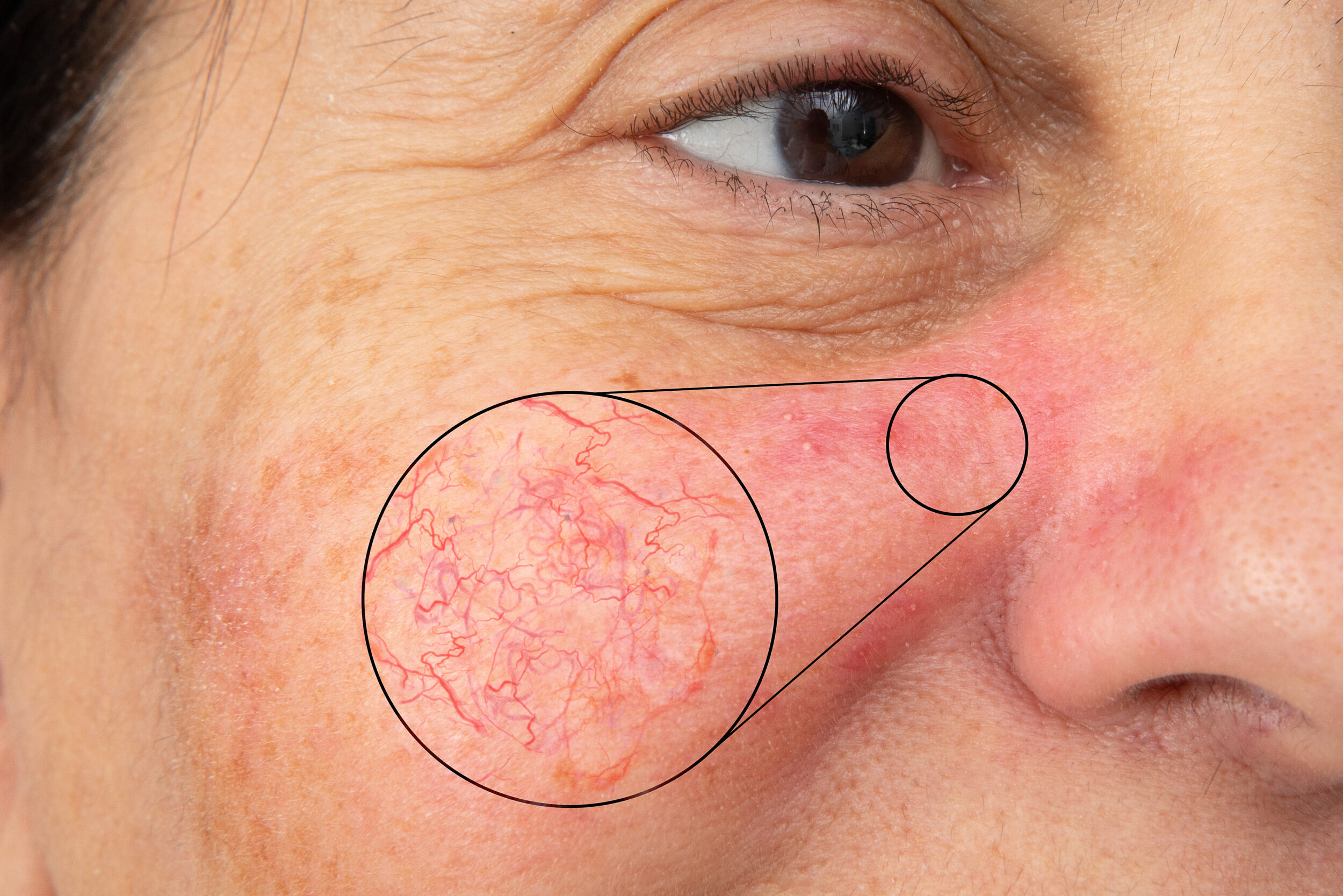 Facial spider veins on a Caucasian woman’s cheek, with a magnified view of red, swollen capillaries related to varicose veins