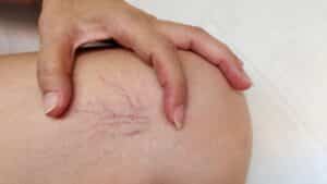 Close-up of woman holding leg showing varicose veins, spider veins, and flabby skin, concept of poor blood circulation and vascular health care.