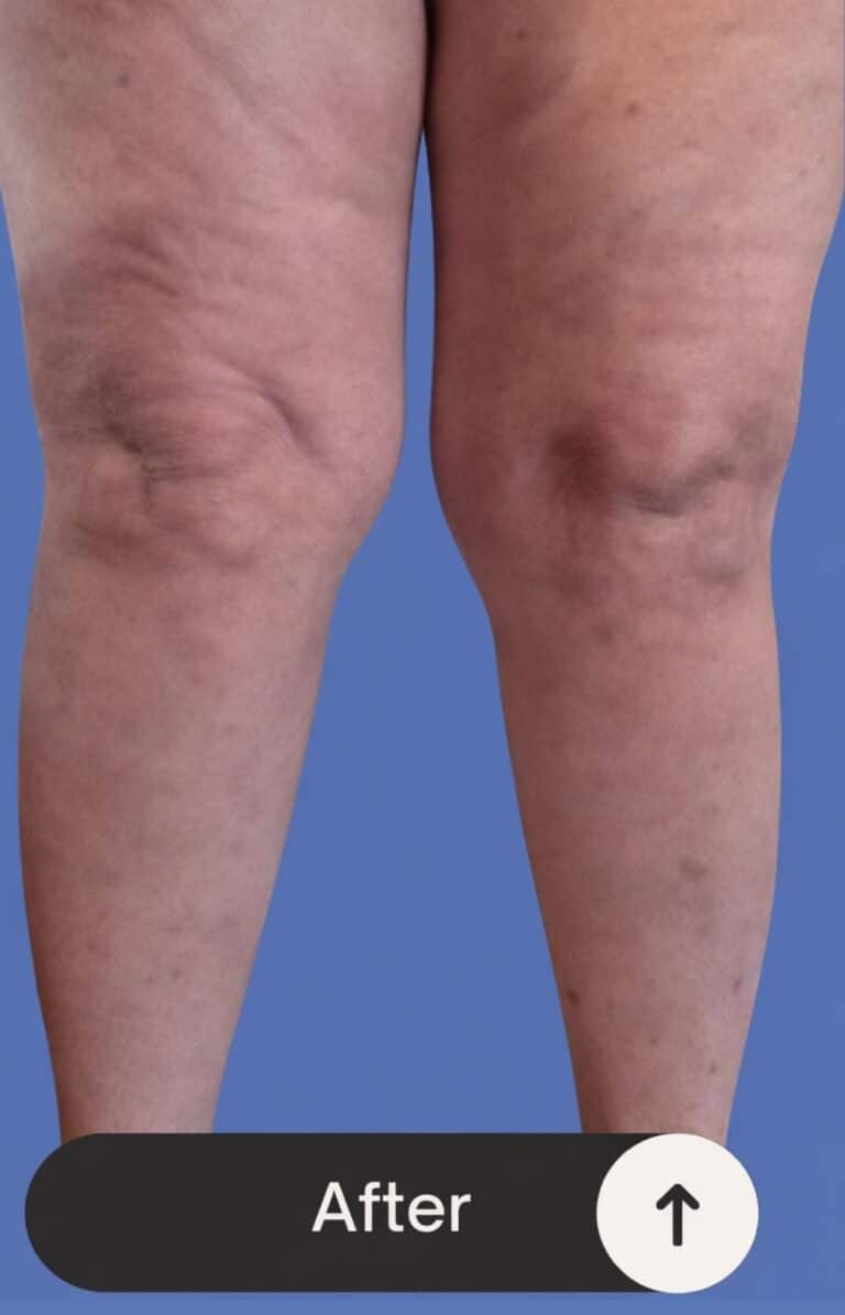 After Image: Bilateral RFA - front