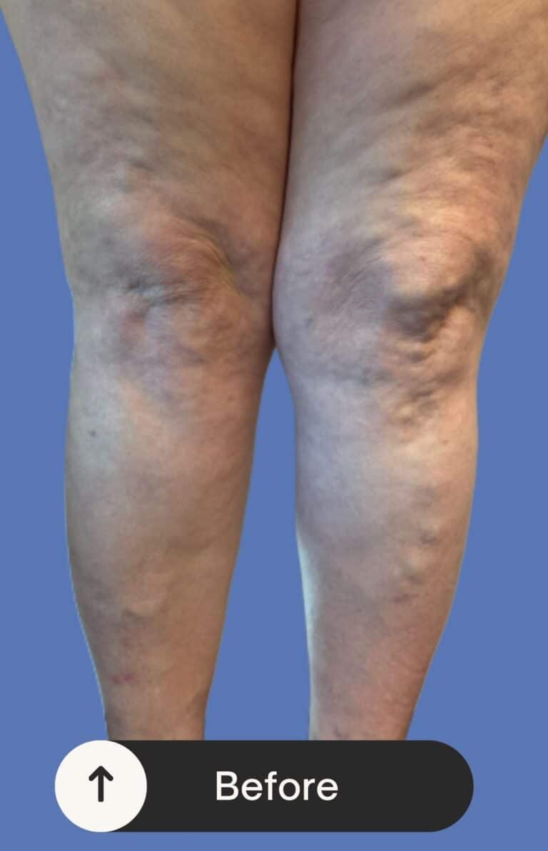 Before Image: Bilateral RFA - front